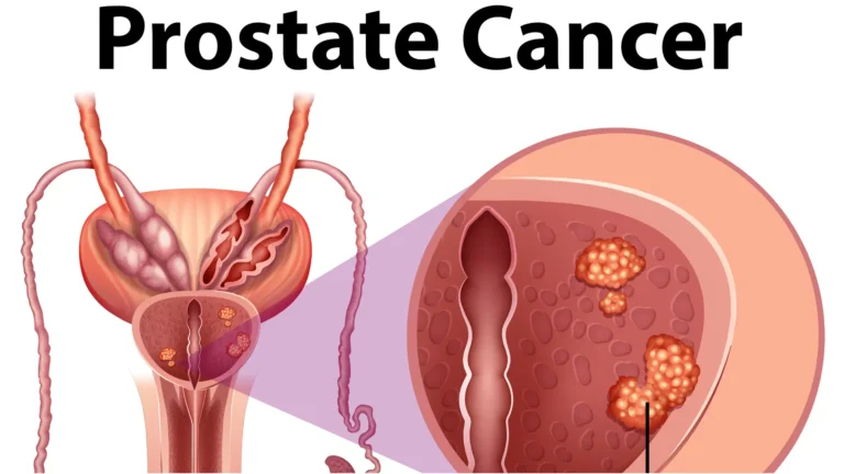 prostate cancer prostate c938d5bfa9430729bb5a54361d22dd21