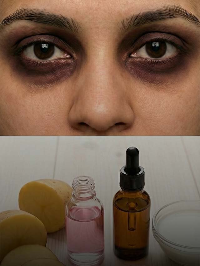 डार्क सर्कल्स से पाना है छुटकारा? अपनाएं ये 5 असरदार घरेलू नुस्खे!